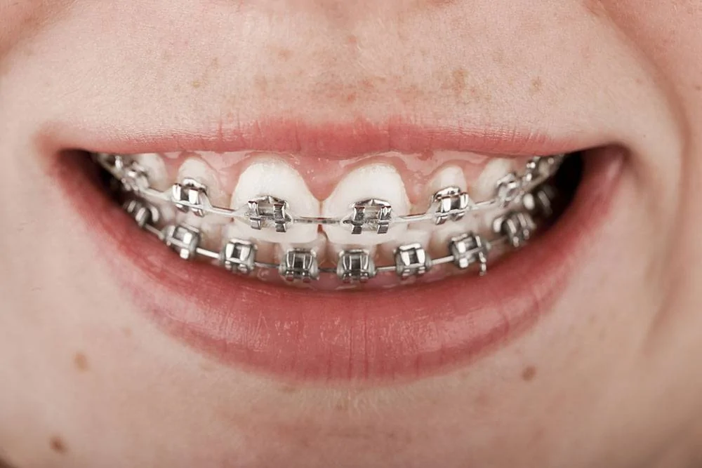 traditional-braces.jpg